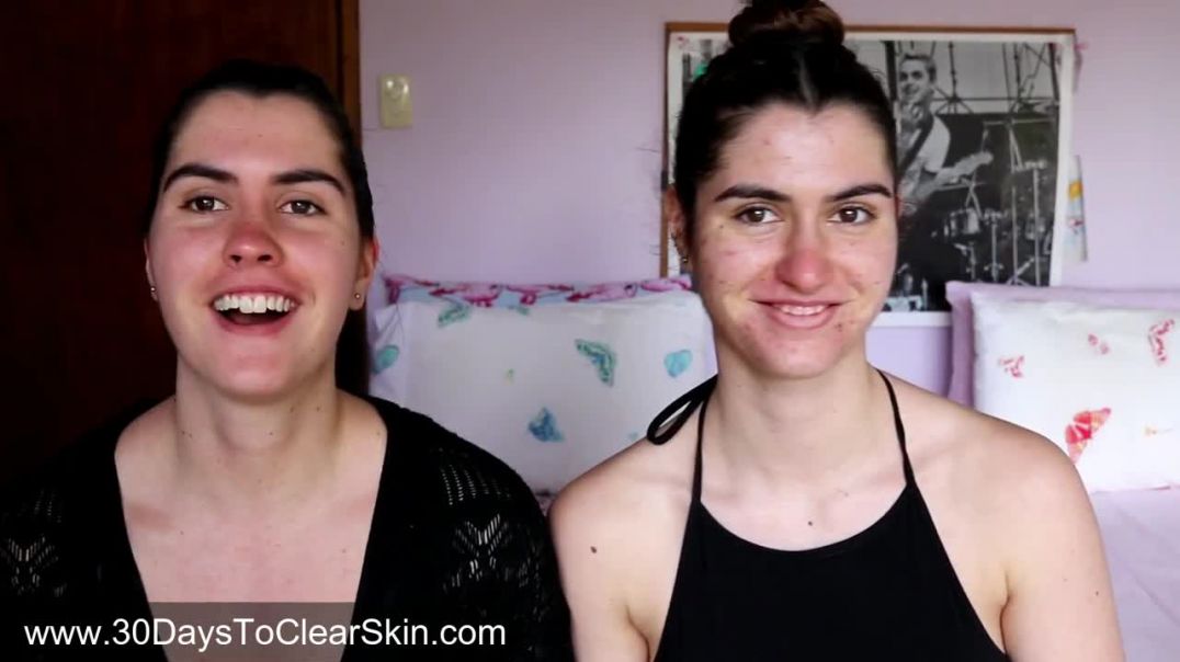 How my Twin Sister cured her Acne naturally (No Accutane)