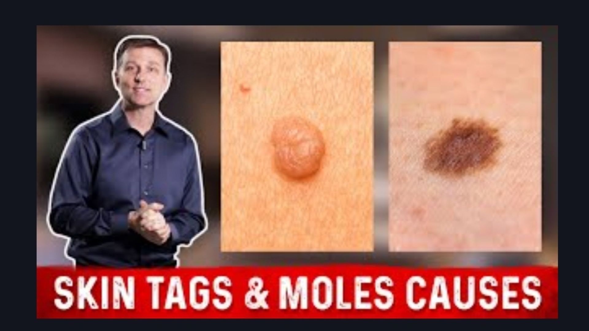 What Causes Skin Tags and Moles? – Dr.Berg